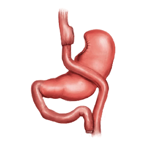 Gastrik Bypass